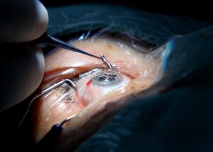 Operación de cataratas en Mérida