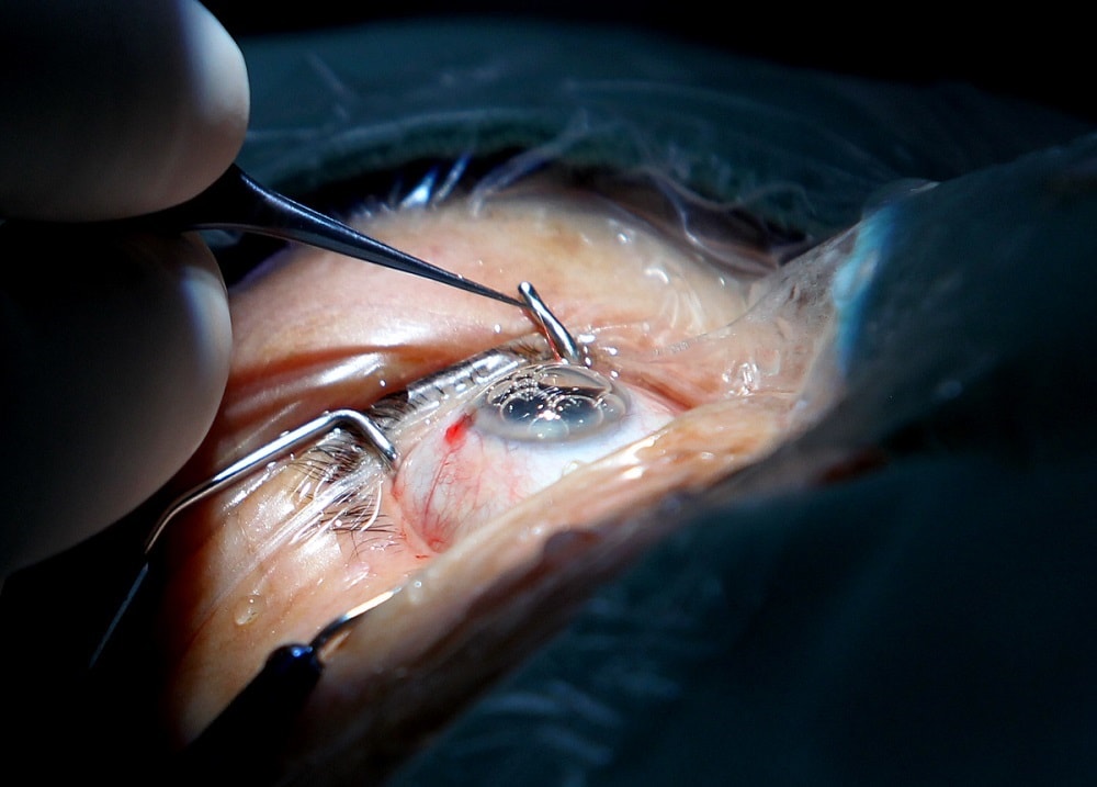 Operación de cataratas en Mérida