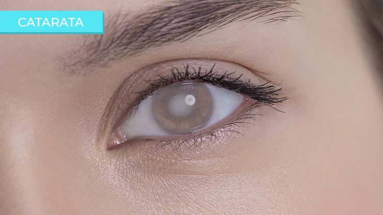 operacion de cataratas en merida