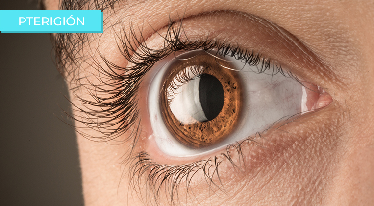 Oftalmólogos en Mérida Yucatán y el valor de las consultas oftalmológicas