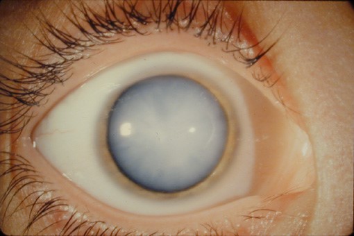 ¿Es posible operar cataratas y glaucoma a la vez?