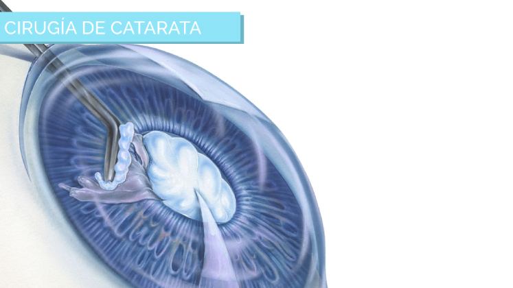 Operación de cataratas en Mérida